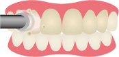 歯のクリーニング